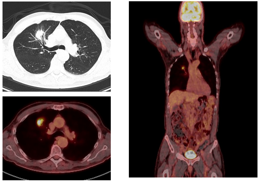 Does PET Scan Detect Small Tumors