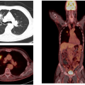 Does PET Scan Detect Small Tumors?